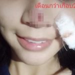 Girl gets severe nose infection from a cheap nose job