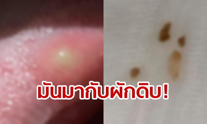 FB User gets Pork Tapeworm on tongue from fresh vegetables
