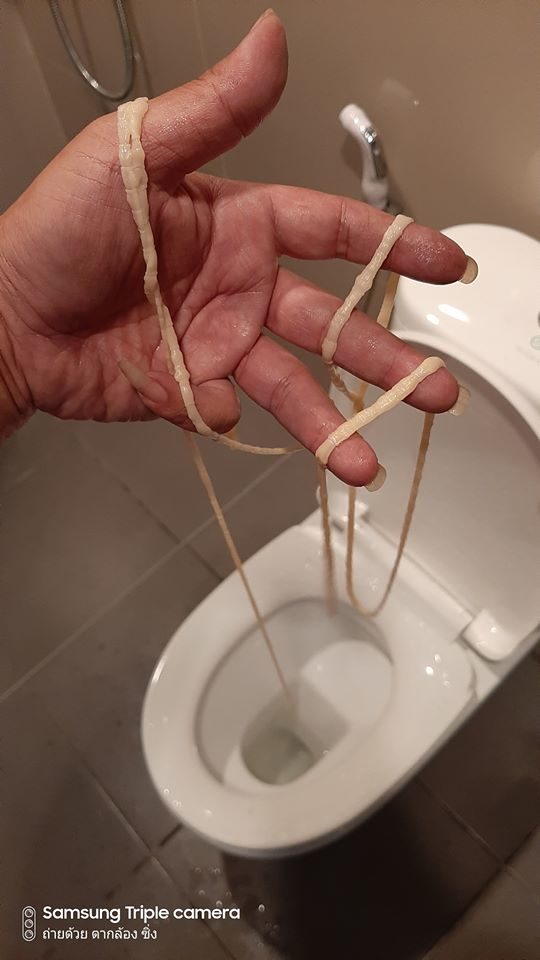 There has been another case of a parasite infection that went viral online, the last story was on a man who pulled out a roundworm from his throat while in this case, a man pulled out an extremely long tapeworm while using the bathroom. The story was shared with multiple photos along with a video from Facebook User “Taklong Zing” in Thai. He captioned the post “What the he** is in my body”. The photos showed an extremely long tapeworm placed on top of the toilet. The image gets worse in the video that shows the tapeworm slowly moving. Credit: Khaosod Credit: Khaosod The Khaosod News Team went to interview Kritsada Radprachum 44 years old, the owner of the story at his home in Udonthani Province. The man was still shocked by the discovery of the disgusting long creature that came out of him. Kritsada explained that he actually just had an appendectomy on 2 December 2019, the stitches are still in place. A few days ago he started having diarrhea even though had not consumed any strange foods. Credit: Khaosod Credit: Khaosod Kritsada explained the scary experience stating “So this morning (9 December 2019) after I sent my child at school I returned home and needed to use the bathroom. While I was there I felt like something was stuck down there. So I stood up to look at what was in the toilet. I realized something was hanging from my behind. At first, the idea of a parasite didn’t come into my head but I thought maybe some stitches from the surgery became loose. Credit: Khaosod Credit: Khaosod I pulled it out and it felt like rubber. I placed it on the toilet, it was about 10 meters long. This is when I saw it moving. I realized that it was alive and showed it to my girlfriend who is a nurse. She told me it was a tapeworm. I was shocked because I’ve never seen anything like this before. I quickly threw it back into the toilet and flushed it down.” Kritsada admitted that he never worried about having parasites. The last time he took Anthelmintics to deworm was when he was still a little boy. He hardly eats raw food and barely touches vegetables.