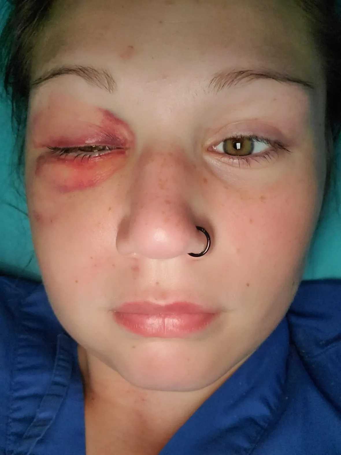 After the accident, Cathryn Ferster's face entire face swelled up. She needs urgent surgery before March 31 or else doctors say the bones in her face will set incorrectly. (Cathryn Ferster)