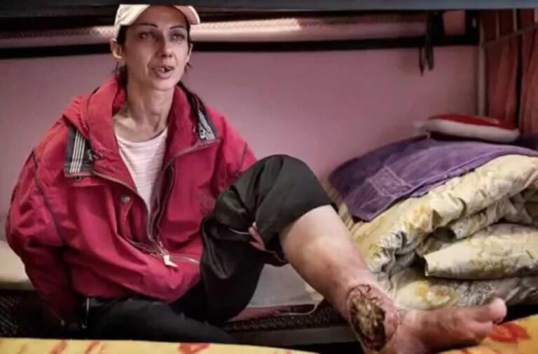 Flesh Eating Drug Krokodil Has Hit The Uk Pattaya One News