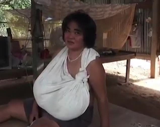 Thai woman’s breasts won’t stop growing
