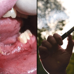 Vape Explodes In Teenager's Mouth Breaking Their Teeth