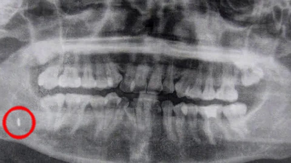 Woman had tip of dental tool embedded in gum for five years