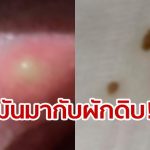 FB User gets Pork Tapeworm on tongue from fresh vegetables