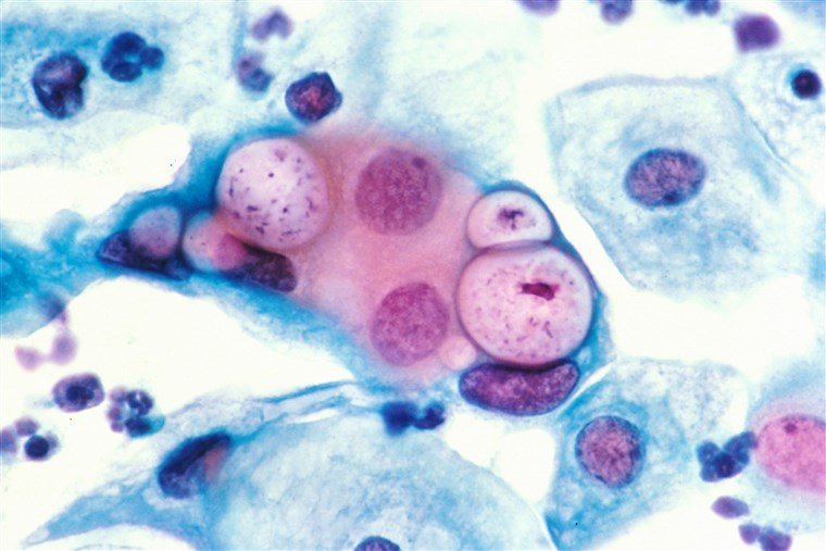 First ever chlamydia jab could prevent most common STI
