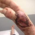 Cobbler Has Toe Stitched To Hand After Losing Thumb In Accident