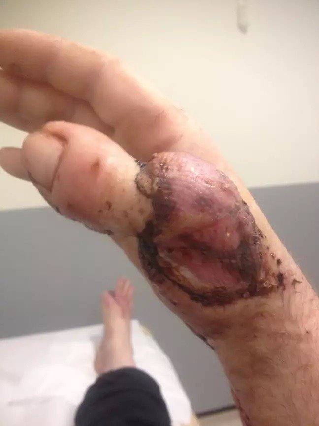 Cobbler Has Toe Stitched To Hand After Losing Thumb In Accident