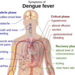 Dengue_fever_symptoms